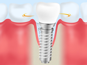 インプラント周囲炎について