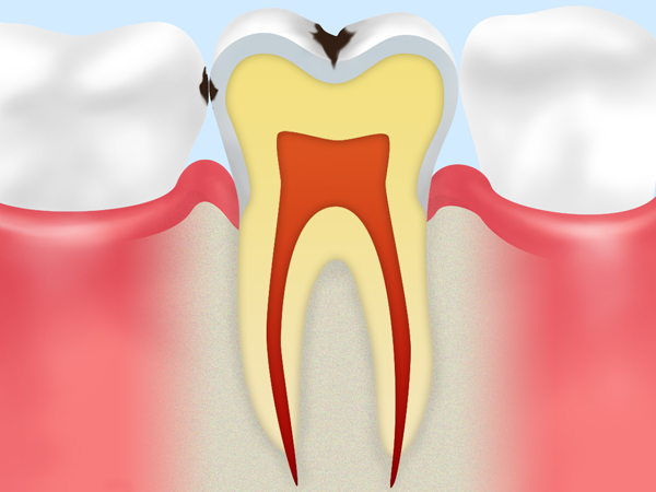C1 エナメル質の虫歯