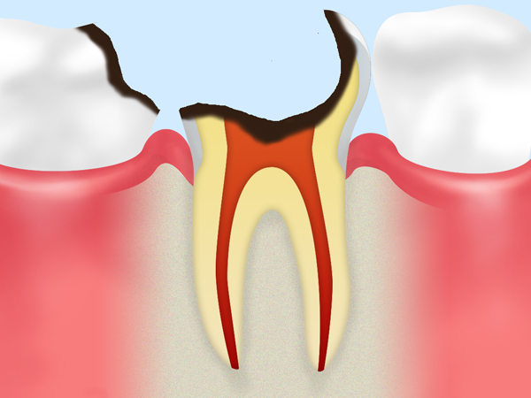 C4 歯根だけになった虫歯