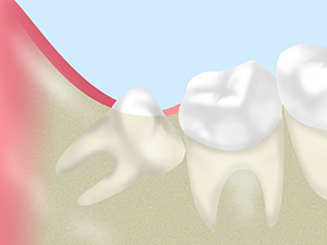 親知らずの痛みもご相談ください