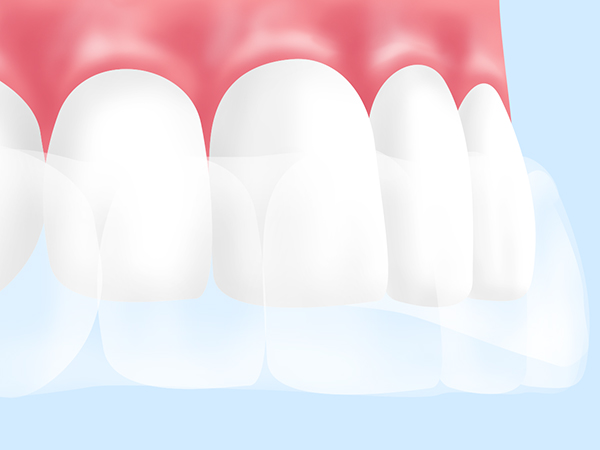 当院のホワイトニング～ホームホワイトニング～